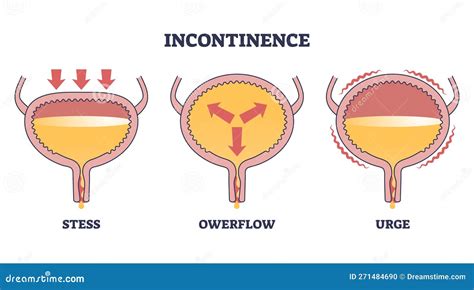 fapdeciders|Urinary incontinence .